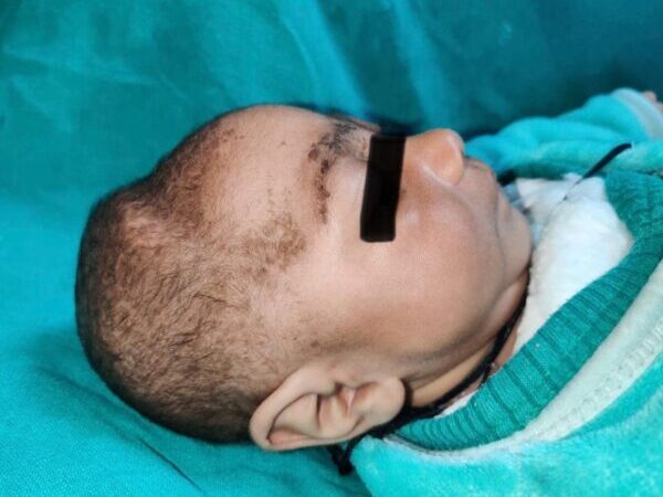 एम्स ऋषिकेश में डेढ़ माह के शिशु के सिर को सर्जरी से दिया गोल आकार, जन्म से थी समस्या, यह सुविधा प्रदान करने वाला देश का पहला सरकारी स्वास्थ्य संस्थान