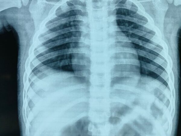 चम्पावत : खेलते-खेलते बच्चे ने निगला सिक्का, डॉक्टरों ने एंडोस्कोपी से बचाई जान