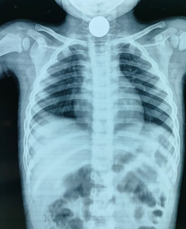 चम्पावत : खेलते-खेलते बच्चे ने निगला सिक्का, डॉक्टरों ने एंडोस्कोपी से बचाई जान