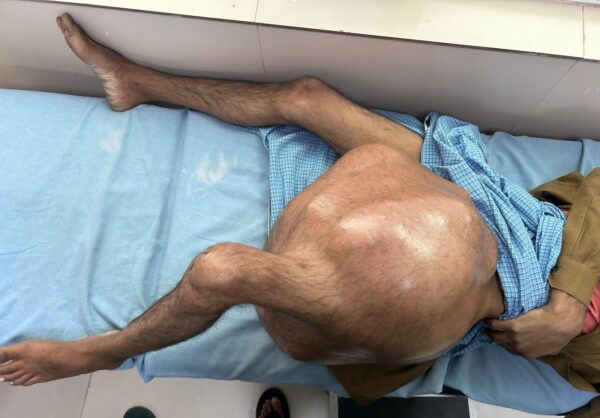 एम्स ऋषिकेश ने रचा इतिहास, सर्जरी से हटाया 35 किलो का बोन ट्यूमर, डाॅक्टरों ने बचायी जान