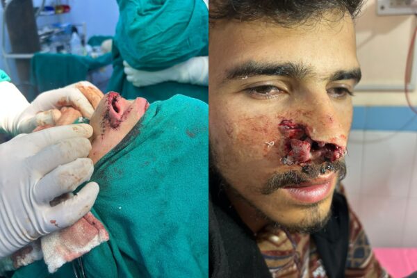 चमत्कार! जिला अस्पताल गोपेश्वर में डॉक्टरों ने किया कुत्ते के काटने से क्षतिग्रस्त नाक का सफल पुनर्निर्माण, 23 वर्षीय साजन सिंह को मिली नई जिंदगी