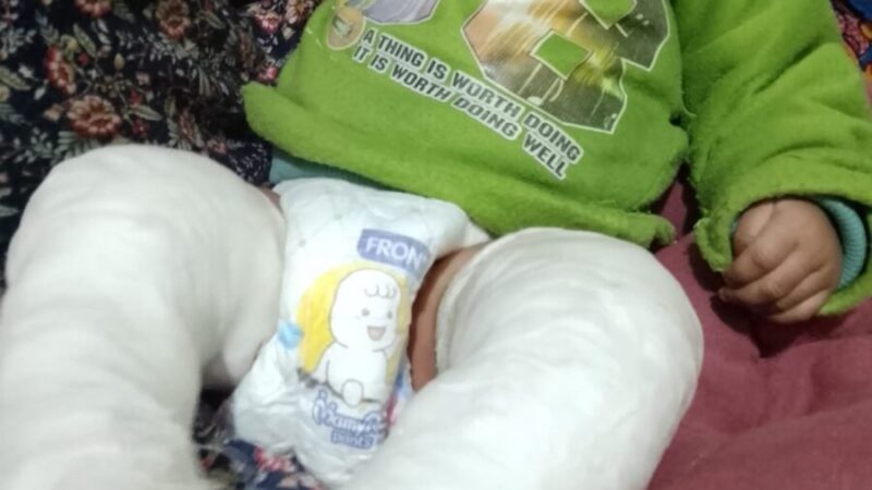 RBSK योजना बनी नवजात के लिए वरदान, ‘क्लब फुट’ से ग्रसित शिशु का सफल उपचार