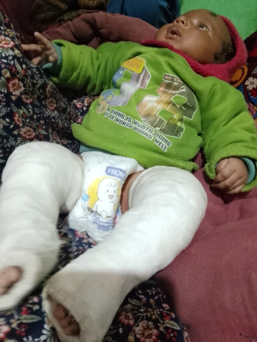 RBSK योजना बनी नवजात के लिए वरदान, ‘क्लब फुट’ से ग्रसित शिशु का सफल उपचार