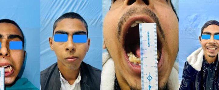 सतत उपलब्धियों का पर्याय बना एम्स, दंत चिकित्सा विभाग ने दिखाया उच्च कौशल, बिना कृत्रिम जोड़ के जन्मजात चेहरे की विकृति का सफल सुधार