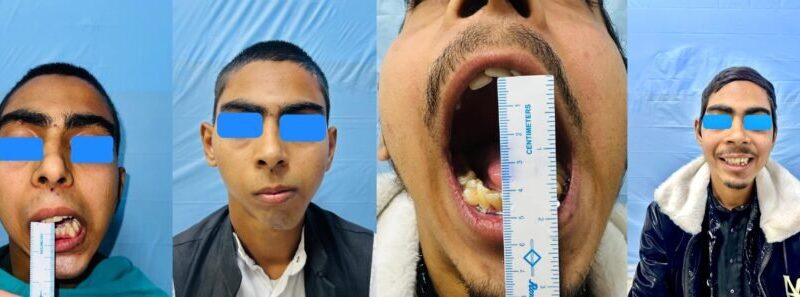 सतत उपलब्धियों का पर्याय बना एम्स, दंत चिकित्सा विभाग ने दिखाया उच्च कौशल, बिना कृत्रिम जोड़ के जन्मजात चेहरे की विकृति का सफल सुधार