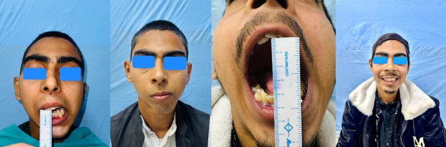 सतत उपलब्धियों का पर्याय बना एम्स, दंत चिकित्सा विभाग ने दिखाया उच्च कौशल, बिना कृत्रिम जोड़ के जन्मजात चेहरे की विकृति का सफल सुधार