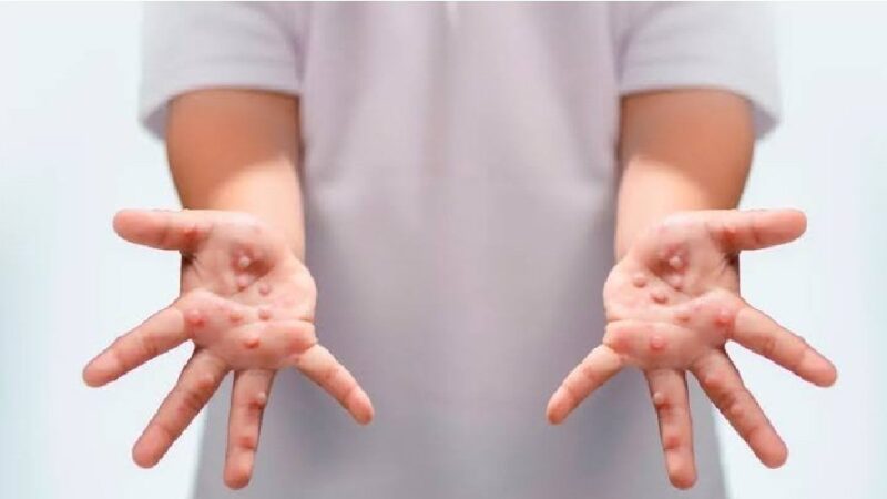 उत्तरकाशी में 15 बच्चे बीमार, आठ में कॉक्ससैकी वायरस की पुष्टि